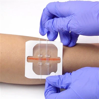 Medical Skin Closure Application Wound Closure