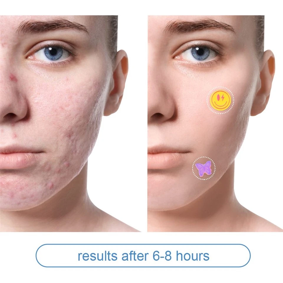 Private Label Acne Cover Patch Sticker Hydrocolloid Acne Pimple Patch For Skin Care