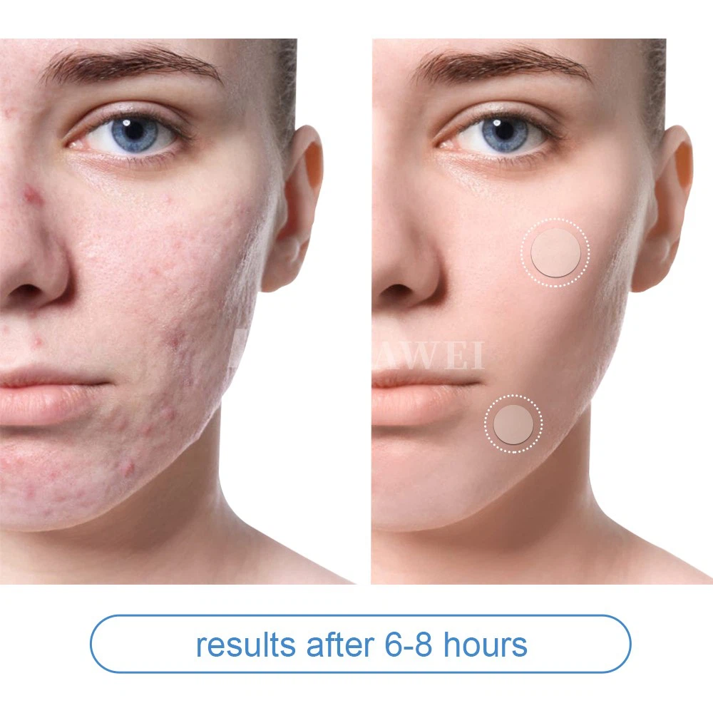 Acne patch 25 Acne patch 25